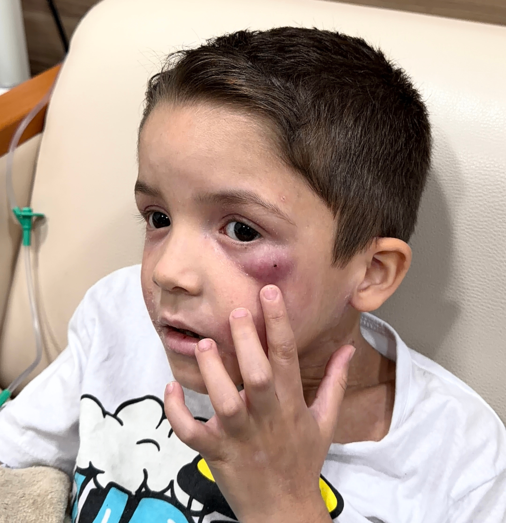 Feridas no rosto causadas pela dermatite